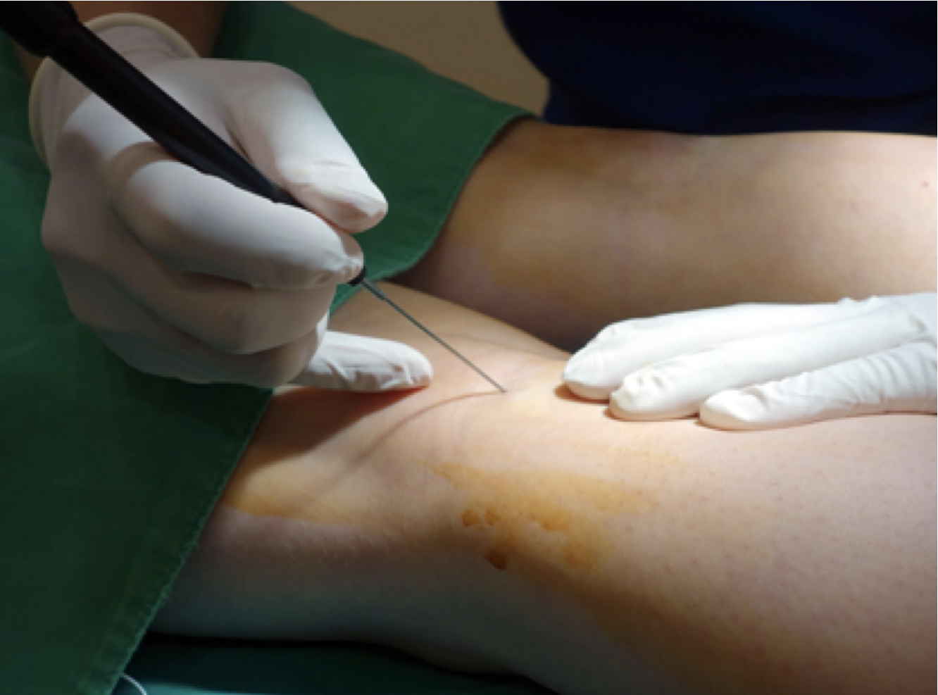 Neuromuscular compensation strategies analysis